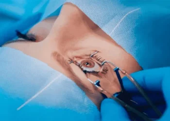 Cataract Surgery in Mumbai