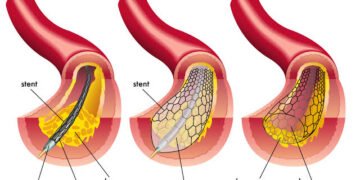 Peripheral Angioplasty Procedure