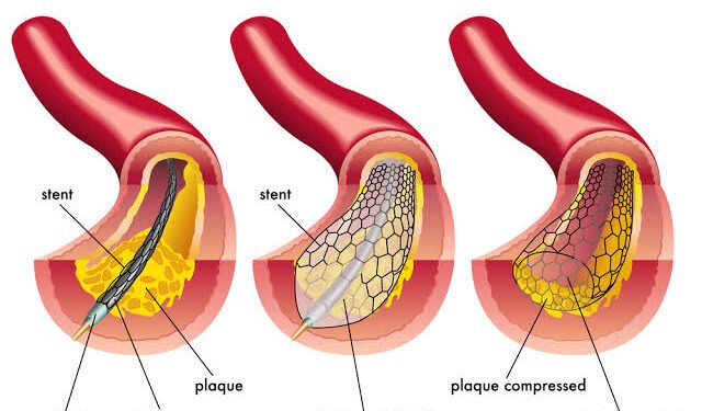 Peripheral Angioplasty Procedure